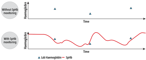 Masimo – SpHb – Graphique de l’intérêt du monitoring de la SpHb