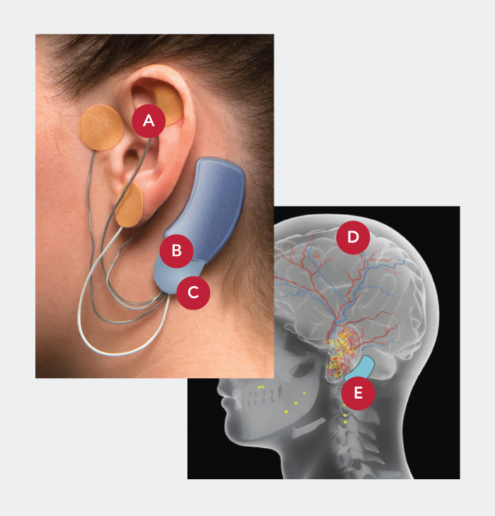 Masimo – Application de Bridge sur l’oreille avec références sur la photo et illustration du cerveau avec références